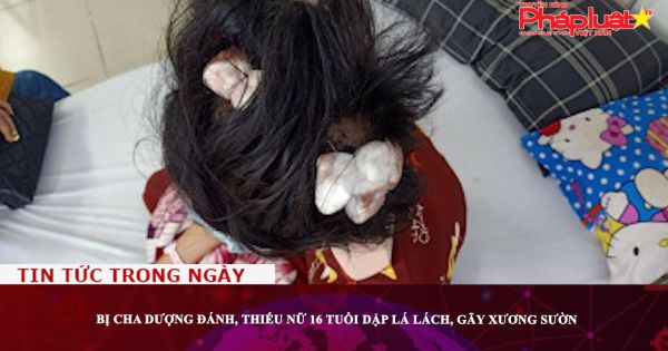 Bị cha dượng đánh, thiếu nữ 16 tuổi dập lá lách, gãy xương sườn