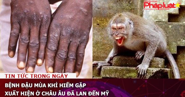 Bệnh đậu mùa khỉ hiếm gặp xuất hiện ở châu Âu đã lan đến Mỹ